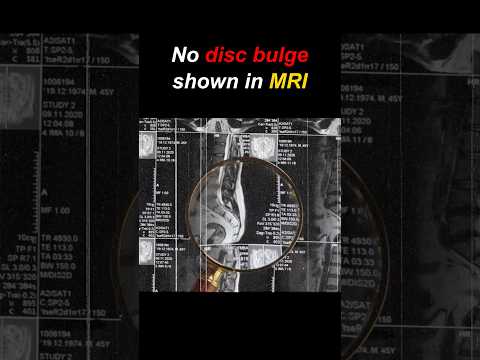MRI me chhota disc bulge, pain zyada kyun? DRG ka secret samjho!