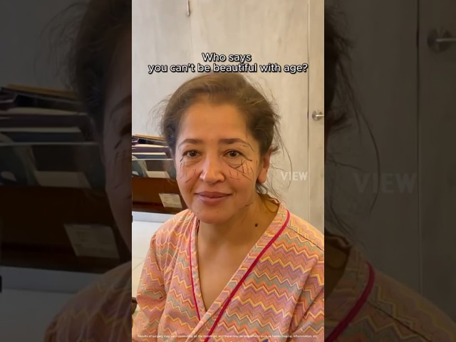 Who says you can’t be beautiful with age? 🌹#antiaging #facelift #necklift #aging #plasticsurgery