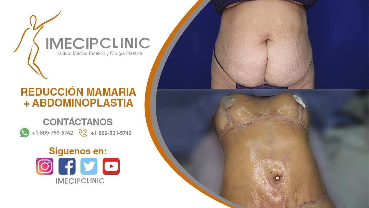 Cuanto cuesta una abdominoplastia en españa