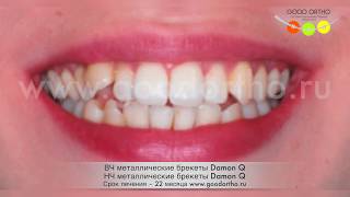 Постановка в зубной ряд дистопированных клыков