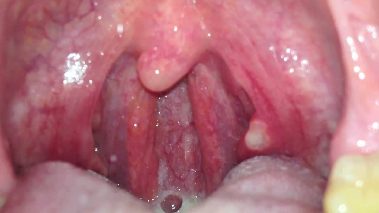 Picture Of Nasal Drainage Down Back Of Throat 9