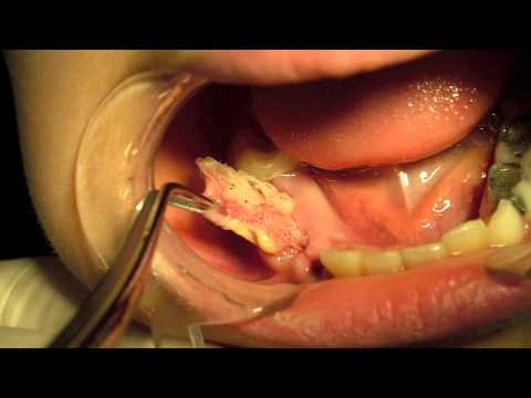 Dentigerous Cyst Marsupialization - YouTube