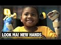 Thanks to Double-Hand Transplant This Little Boy Flaunts New Hands