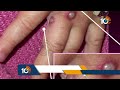 LIVE - భారత్‏లో మరో కొత్త వైరస్ కలకలం..! | Multi-country monkeypox outbreak | 10TV - 11:54:56 min - News - Video