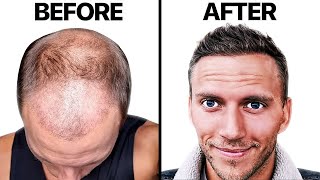 AWFUL Hair Transplant 4 Month RECOVERY | Hair Surgeon Reacts