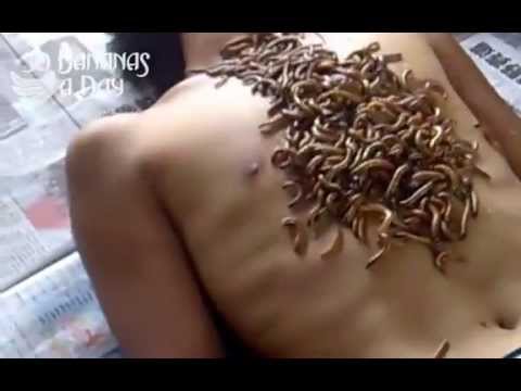 Video Of Doctors Pulling Larvae From Woman'S Boob 112