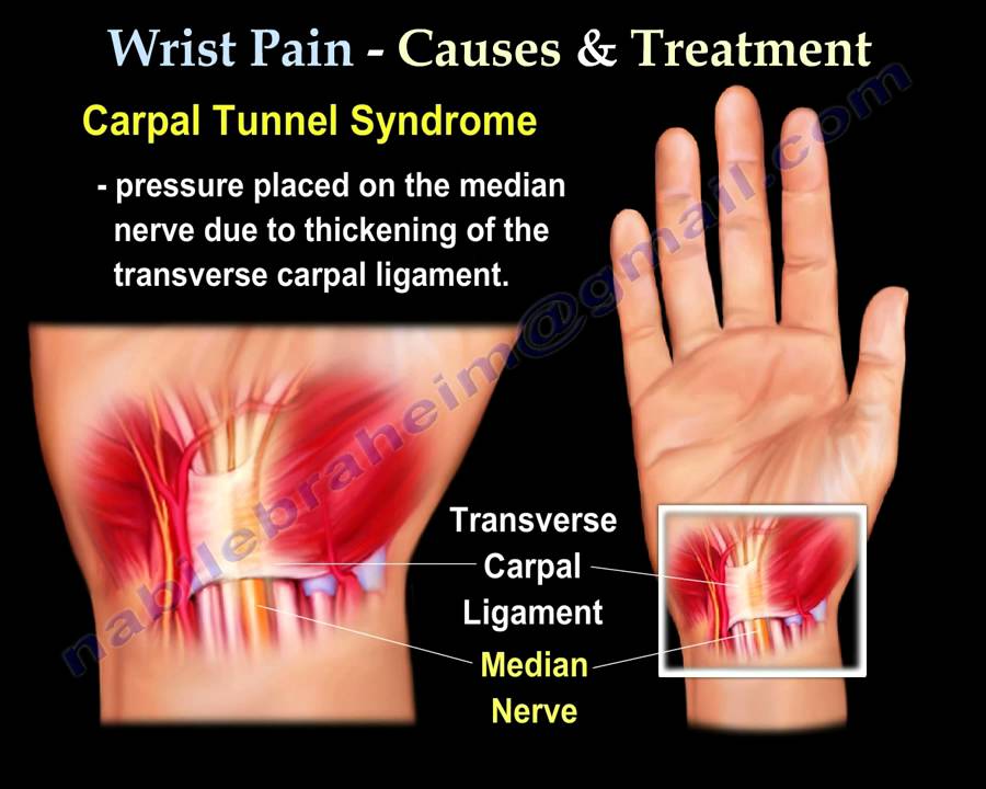 Wrist Pain causes And Treatment PART I Everything You Need To Know 
