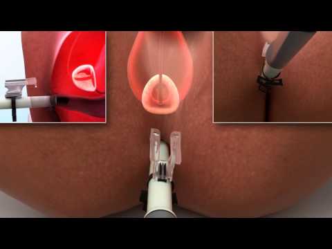 The PrecisionPoint™ Transperineal Access System: Reinventing the Prostate Biopsy