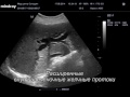 Нажмите для просмотра : Tumor головки поджелудочной железы. Билиарная гипертензия.