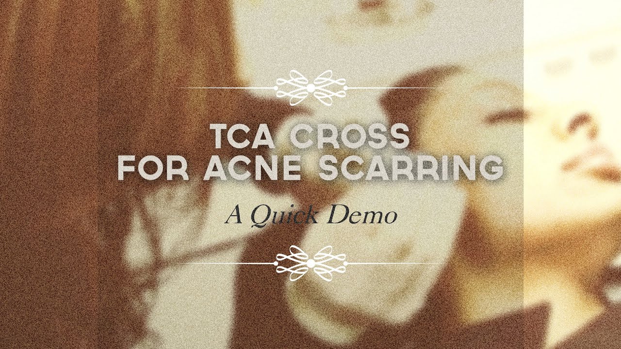 Effective way to improve your pitted scars: TCA cross method