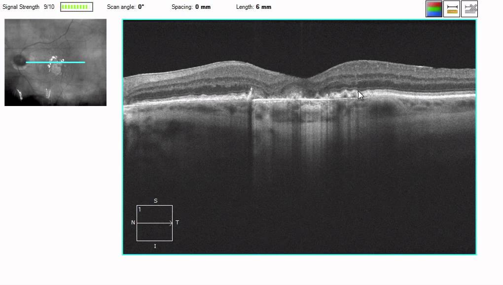 OCT Tutorial: Geographic Atrophy in Dry AMD - YouTube