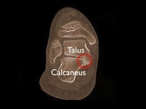 Resection of Talocalcaneal Tarsal Coalition and Fat Autograft Interposition