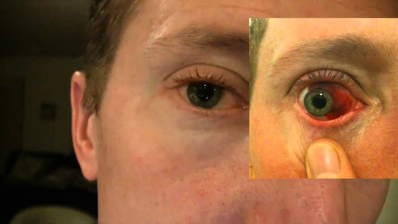 39 Days After Subconjunctival Hemorrhage Burst Blood Vessel In My Eye 