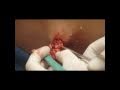boils, cysts & pimples... Oh my!!! - YouTube