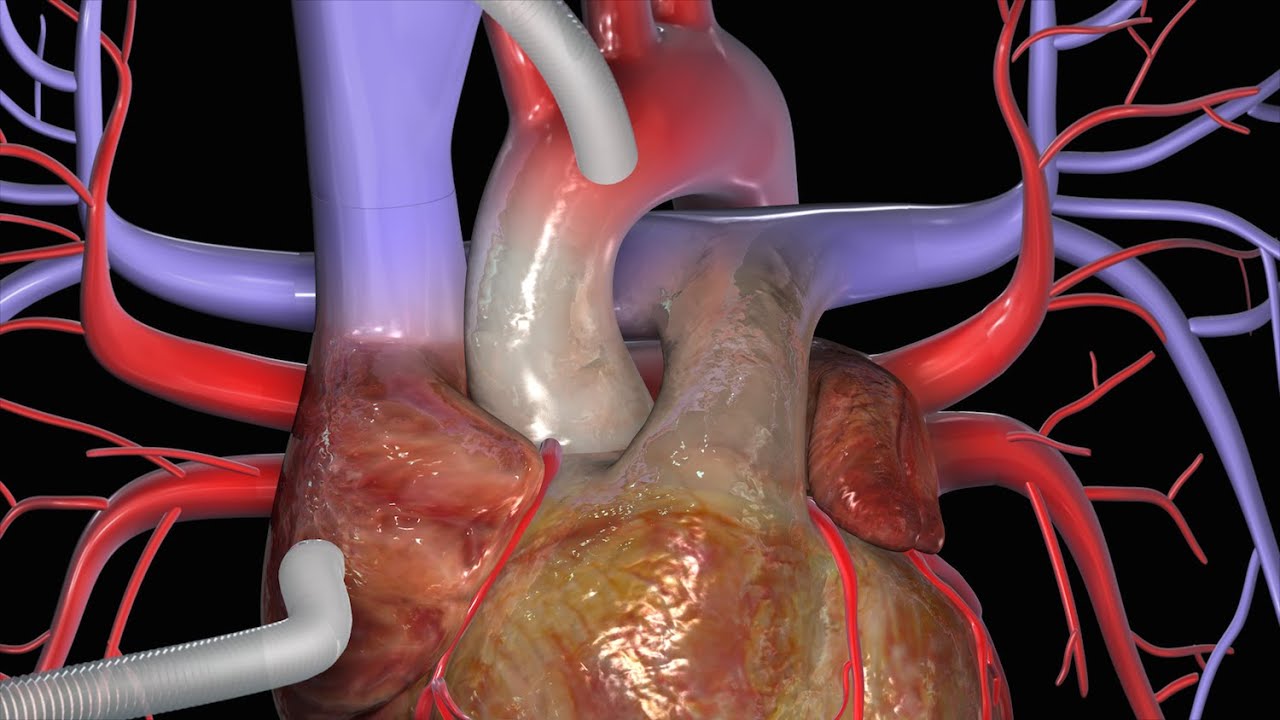 Cirurgia De Revascularização Do Miocárdio Crm Youtube 