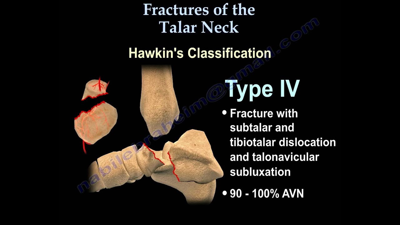 Talus Fracture Hawkins Classificaiton Everything You Need To Know Dr Nabil Ebraheim Youtube 6618