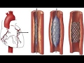 Govt cuts coronary stent prices by 85 % in major relief to cardiac patients