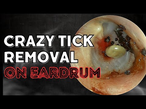 Crazy Tick Removal On Eardrum