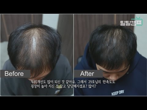 탈모다큐멘터리 29호 정수리탈모 M자탈모치료 마지막이야기 (feat.안산엔비의원)
