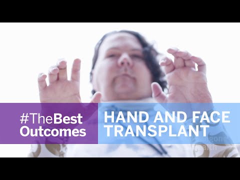 A 22-year-old from New Jersey has received the world’s first successful face and double hand transplant at NYU Langone Health.