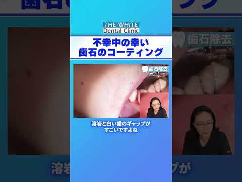 【生配信切り抜き】 不幸中の幸い 歯石のコーティング #歯医者 #dentist #歯石除去