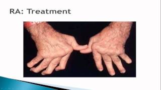 Reumatoid arthritis tünetei és kezelése - HáziPatika