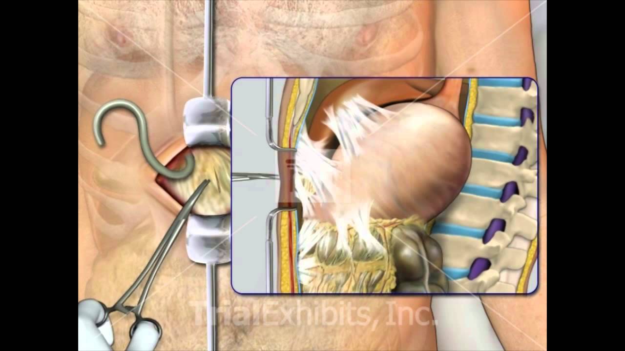 Ventriculoperitoneal Shunt Complications Medical Animation YouTube Ventriculoperitoneal Shunt Complications Medical Animation YouTube