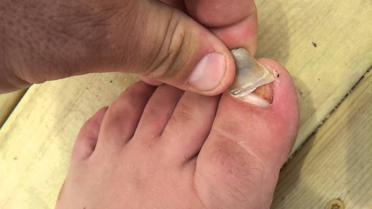 reomoving-my-disgusting-dead-toenail-youtube