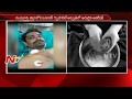 Doctors attach broken hand of man in Guntur