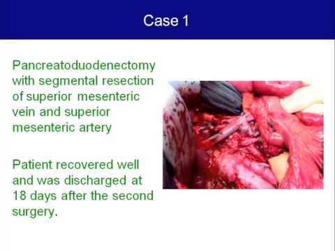 En bloc arterial resection during pancreatoduodenectomy 