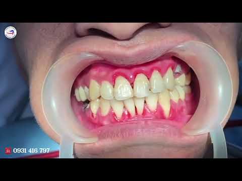 LẤY VÔI RĂNG - NHA KHOA ADENT