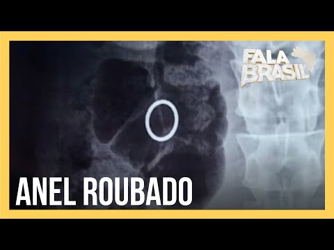 Homem rouba anel e o engole mas é desmascarado por raio x