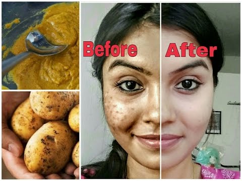 Remove dark spots in just 7 days | 100% Natural | Get rid of uneven skintone