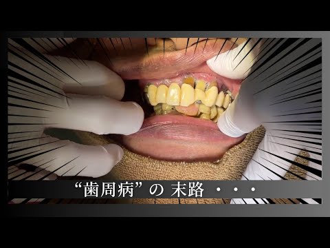 歯周病で歯が限界突破