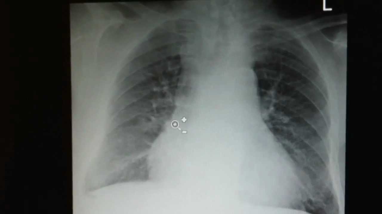 Image Of Chest X Ray With Copd at Alex Mullins blog