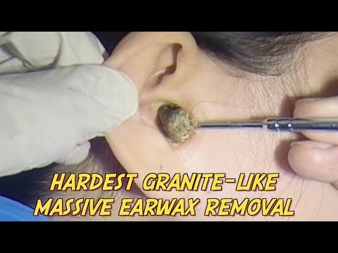 packed wax to how ear remove Satisfying Hair  A  Ingrown VideoMoviles.com