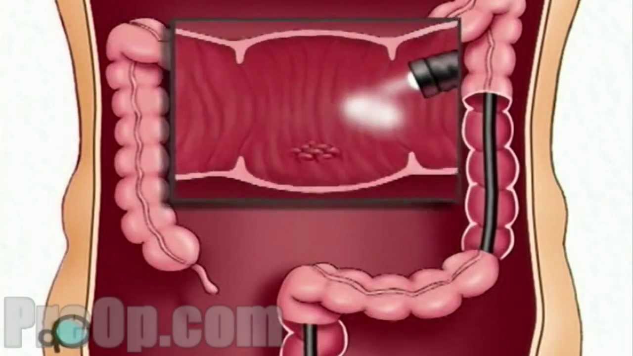 Endoscopy of large intestine surgery patient education hd youtube
