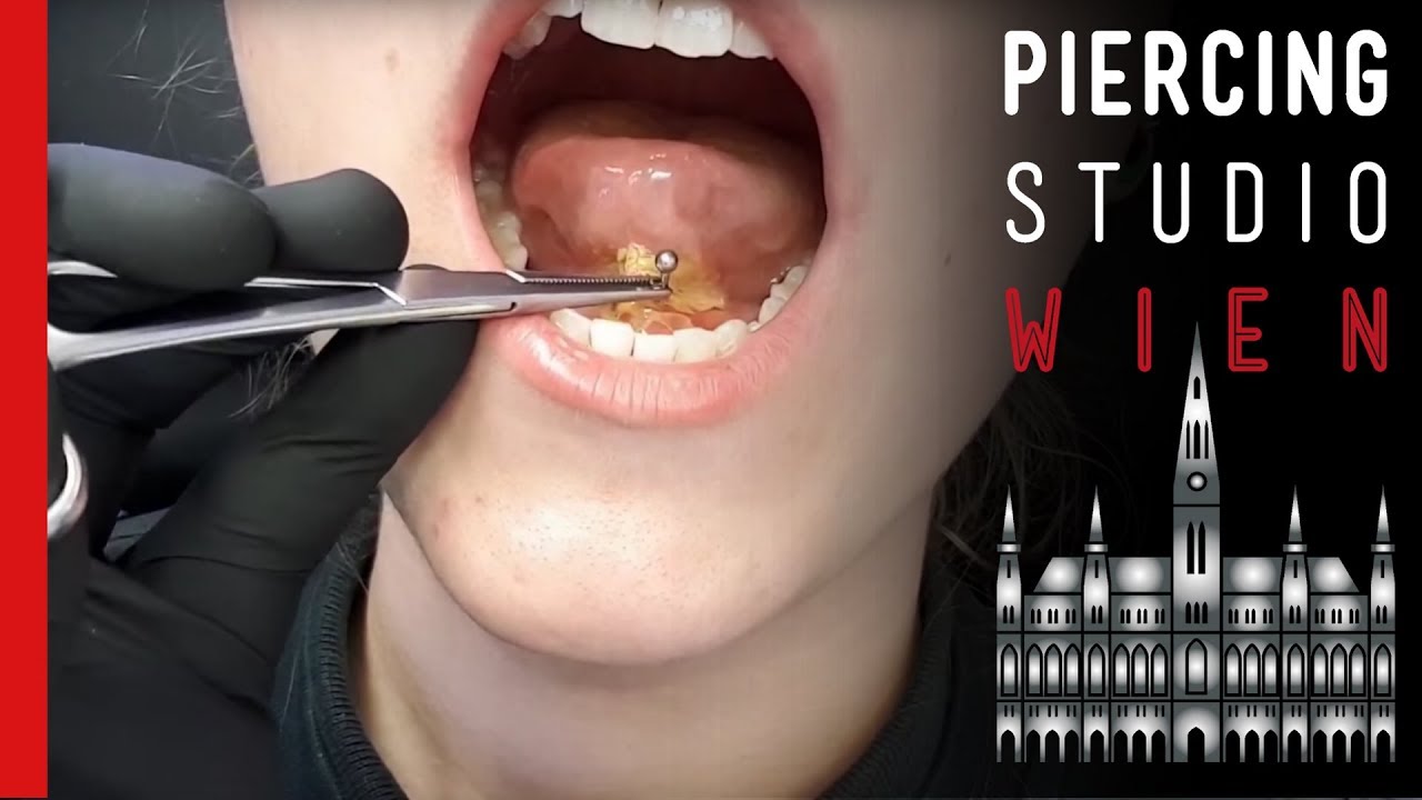 Unter der entzündung zunge zungenpiercing Zungenabszess