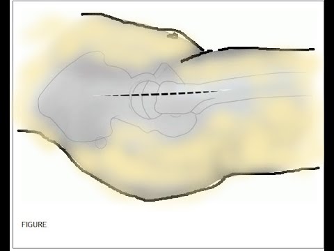 Hardinge Approach  (Antero-Lateral Approach to the Hip )