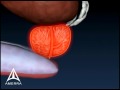 Prostate Biopsy - 3D Animation 