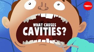 What causes cavities? - Mel Rosenberg