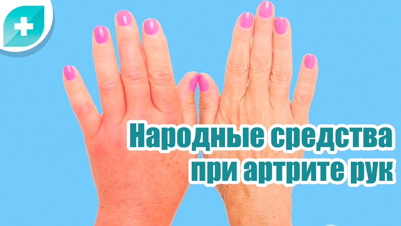 Лечение артрита суставов в домашних условиях. Лекарства от полиартрита пальцев. Препараты от артрита пальцев рук. Препараты от ревматоидного артрита пальцев рук. Народные средства от артрита рук.