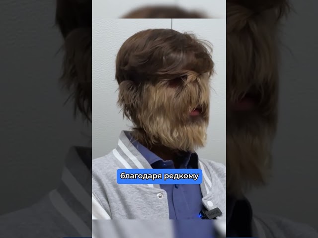 Реальный Йети. Самый волосатый человек на Земле
