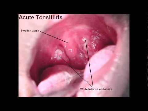 throat Adult onset strep